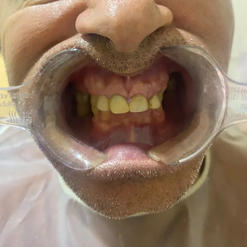 Dentes anteriores com desgaste e manchas, vistos de frente, antes das facetas de porcelana