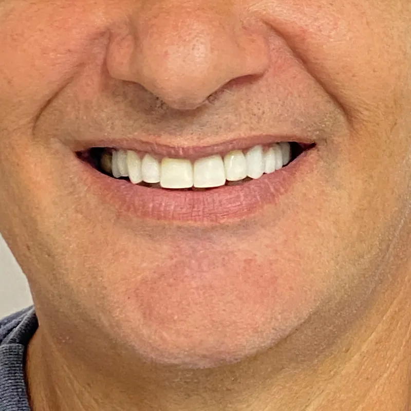 Sorriso visto de frente após as facetas de porcelana