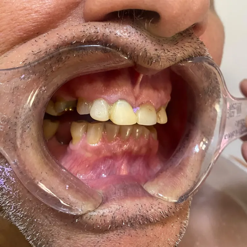 Dentes anteriores vistos de lado, antes das facetas de porcelana
