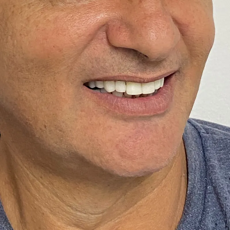 Sorriso visto de lado após as facetas de porcelana