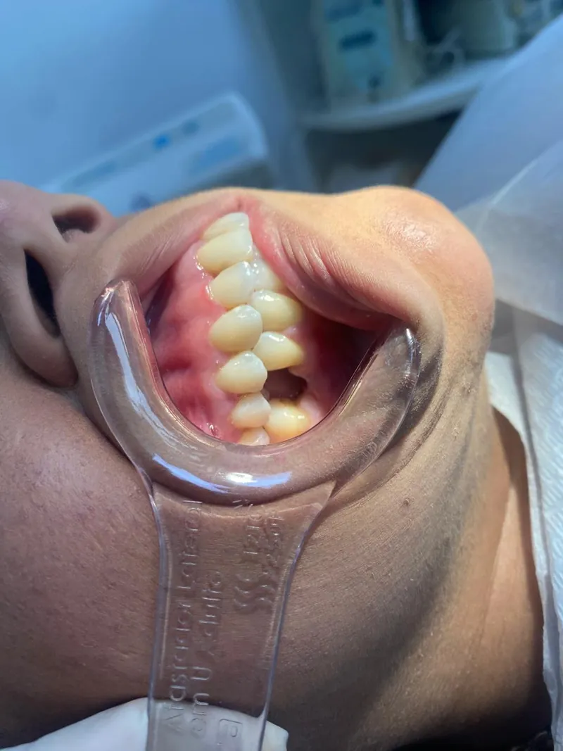Arcada com a falta de um dente, antes do implante