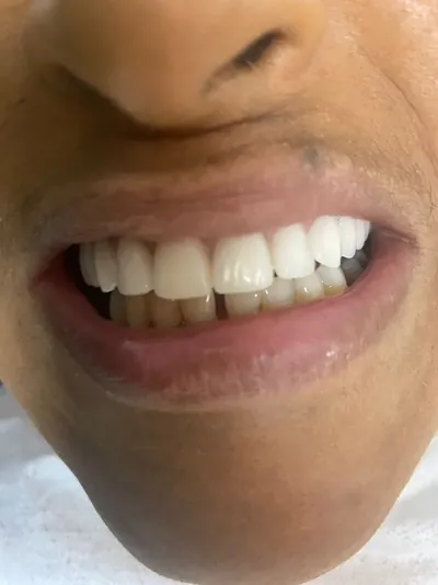 Sorriso de paciente após a prótese protocolo
