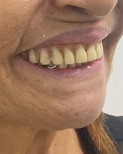 Sorriso de paciente com dentes desgastados, antes da prótese protocolo