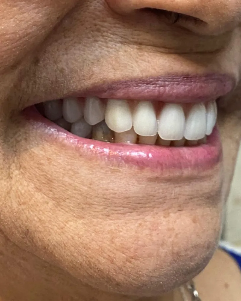 Sorriso de paciente após a prótese protocolo