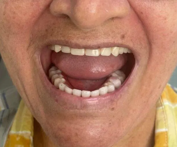 Paciente sorrindo com a prótese protocolo instalada