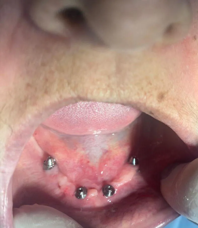 Quatro implantes instalados na arcada inferior durante o tratamento