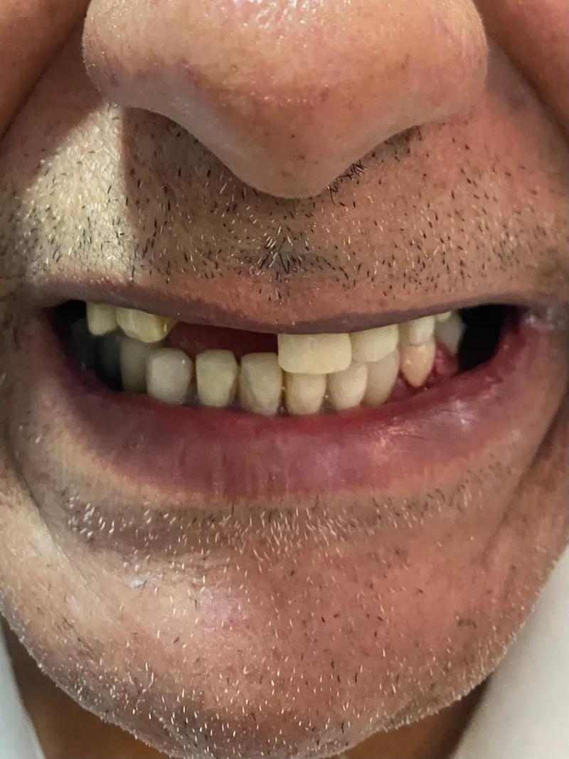 Sorriso com falhas dentárias na arcada superior, antes do tratamento