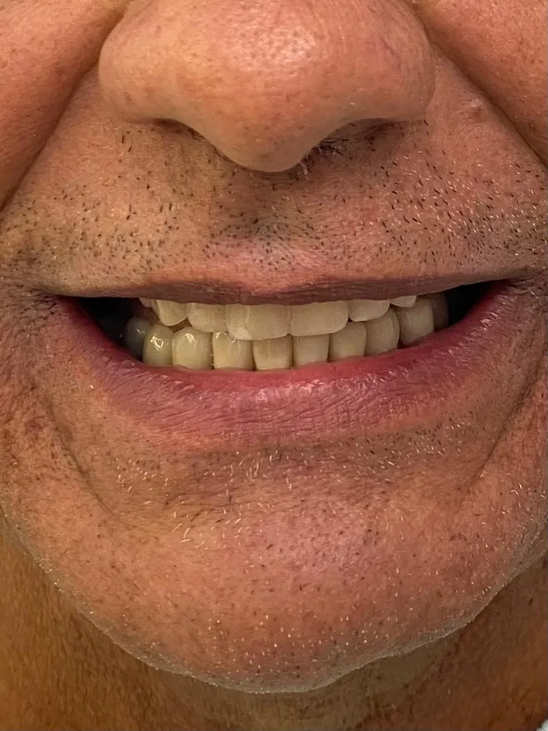 Sorriso após a reabilitação da arcada superior